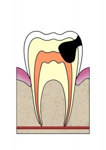 Dentista-Alhaurin-de-la-Torre-–-Caries-y-fluorosis-212x300